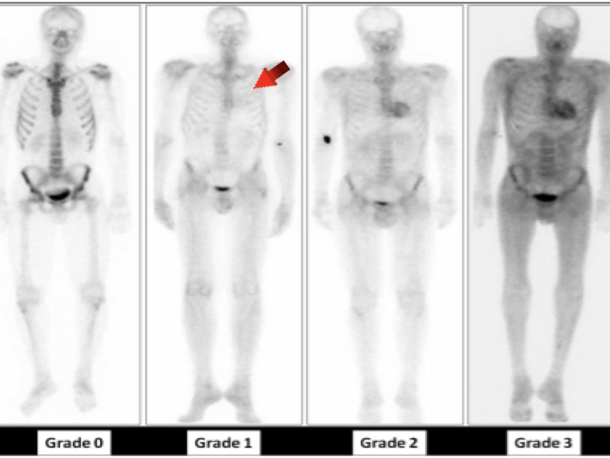 Nuklearmedizinische Bildgebung der kardialen ATTR-Amyloidose - Innere Medizin video ...